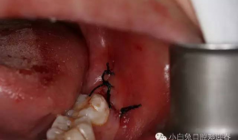 拔牙视频全过程,拔牙手术的惊心动魄瞬间